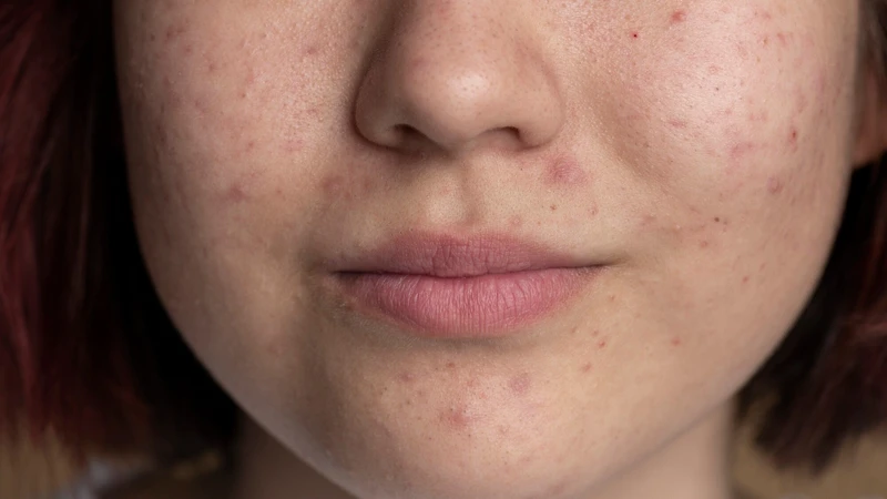 Da nhiễm corticoid là tình trạng làn da bị tổn thương do sử dụng các sản phẩm chứa corticoid trong thời gian dài
