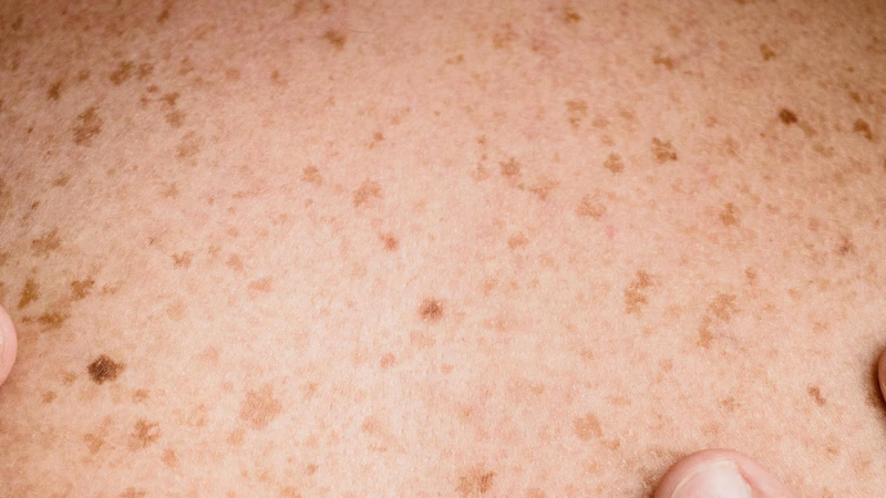 Đốm nâu có thể xuất hiện rải rác ở nhiều vùng da khác nhau trên cơ thể