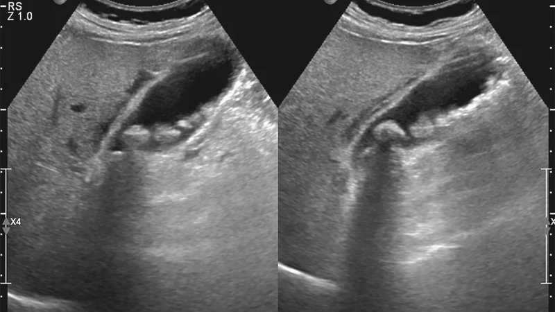 Siêu âm ổ bụng, MRI hoặc CT scan ổ bụng có thể được bác sĩ sử dụng để chẩn đoán và đánh giá polyp túi mật