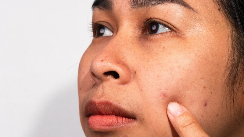 Da xỉn màu do lượng melanin cao