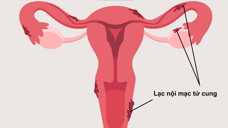 Đau bụng dưới: Nguyên nhân, triệu chứng và phương pháp điều trị 3
