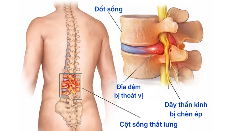 Đau dây thần kinh liên sườn gây khó thở ở vùng lồng ngực