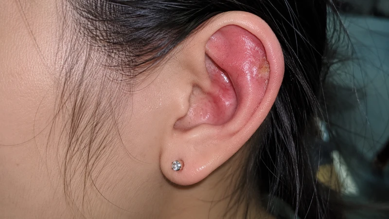Cảm giác ngứa rát kéo dài là dấu hiệu bấm lỗ tai bị nhiễm trùng cần được kiểm tra