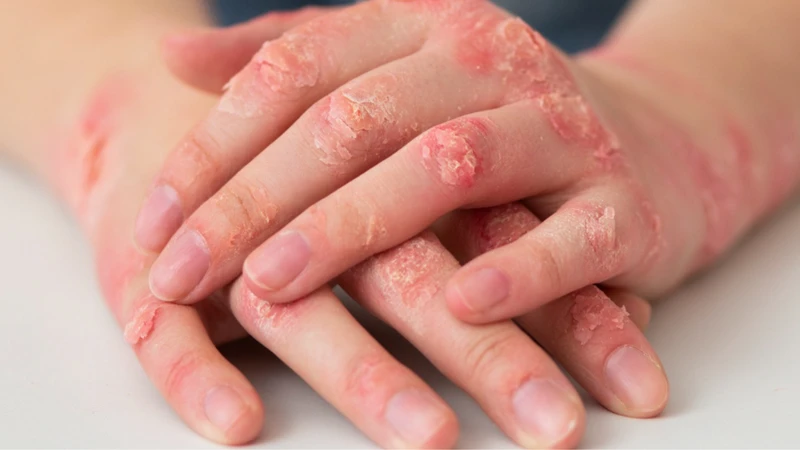 Dấu hiệu giang mai là gì? Biện pháp phòng bệnh giang mai 2