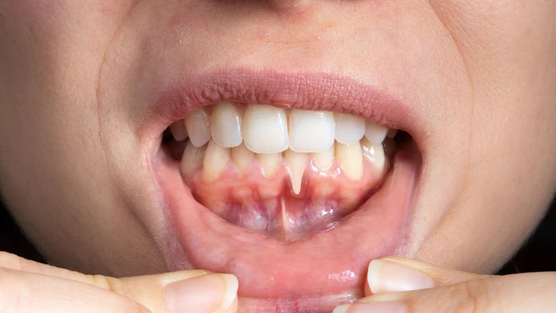 Dấu hiệu HIV ở miệng và những điều cần biết 2