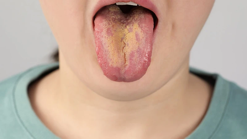 Dấu hiệu HIV ở miệng và những điều cần biết 1