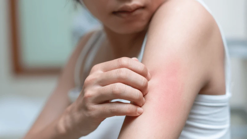 Biểu hiện điển hình là sốt cao đột ngột kéo dài từ 2 – 7 ngày
