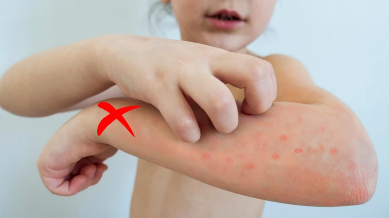 Dấu hiệu khỏi bệnh thủy đậu: Nhận biết đúng thời điểm để chăm sóc hiệu quả 2