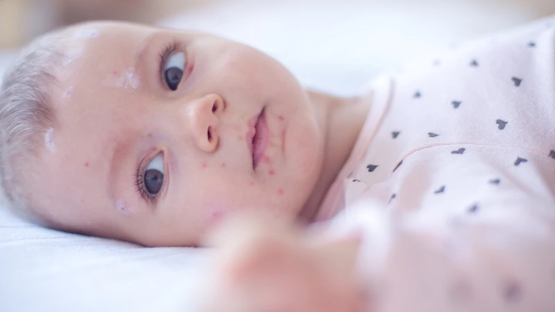 Dấu hiệu khỏi bệnh thủy đậu: Nhận biết đúng thời điểm để chăm sóc hiệu quả 4