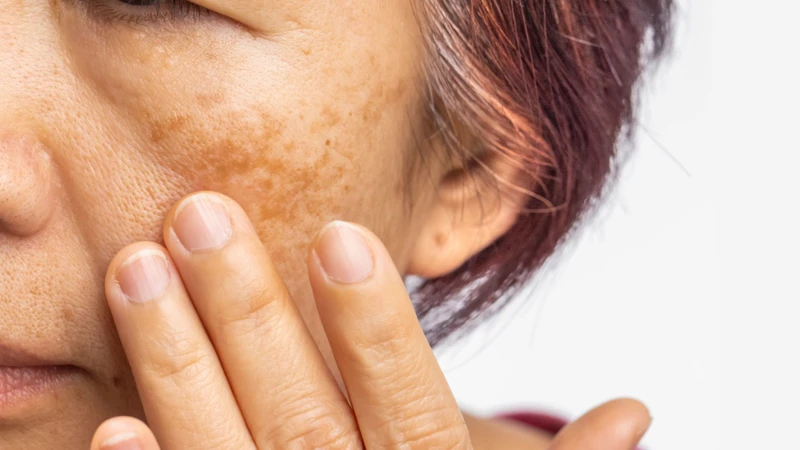 Do lượng estrogen giảm nên khi mãn kinh sẽ có dấu hiệu da khô và nám