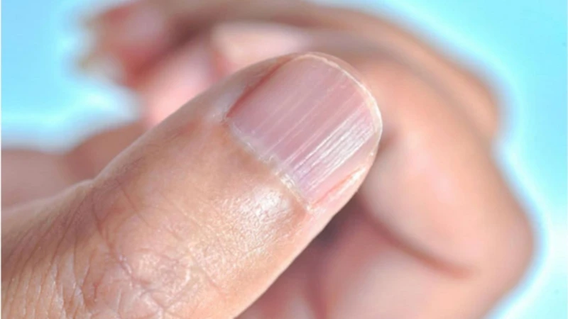 Sọc trắng ngang khiến móng gồ ghề do thiếu dưỡng chất, là dấu hiệu móng tay bị bệnh