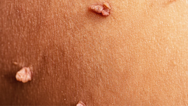 dau-hieu-nhiem-hpv-ban-nen-biet (1).png