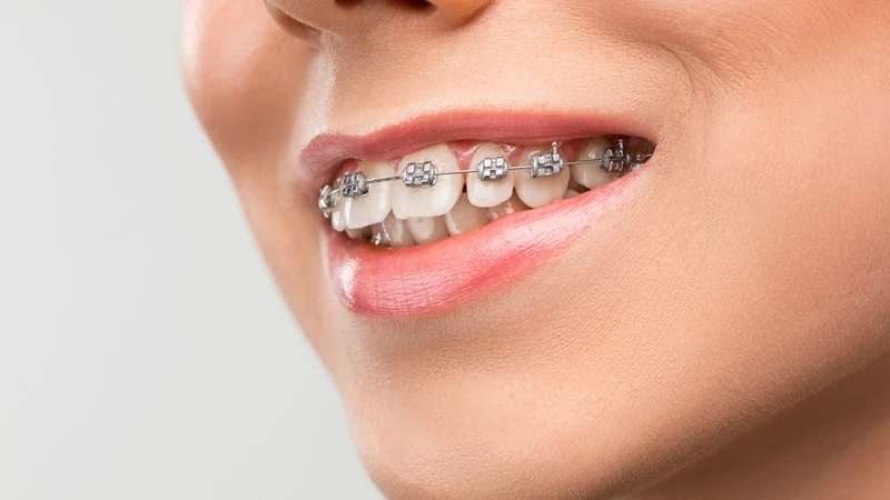 Những người mang niềng răng cần chú ý vệ sinh răng miệng vì việc làm sạch có thể khó khăn hơn