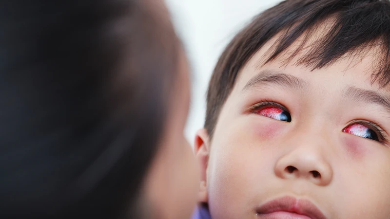Trẻ bị đau mắt đỏ kèm sốt cao khiến nhiều phụ huynh lo lắng
