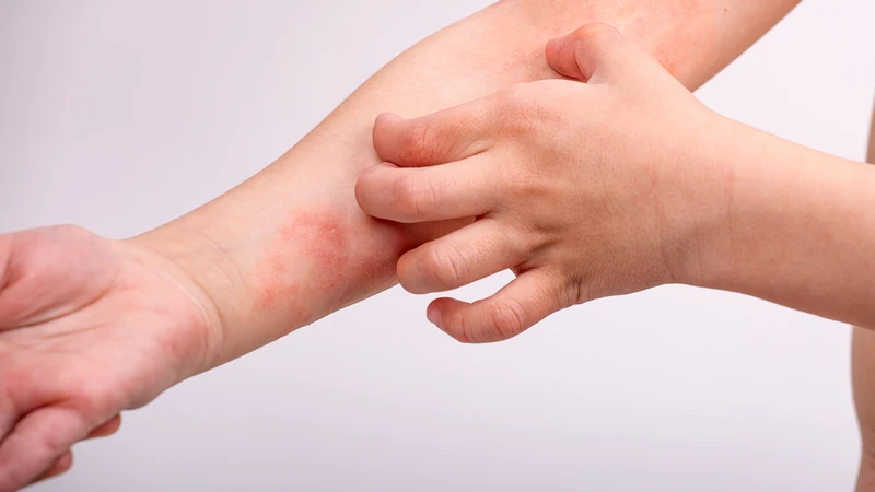 Nên đi khám khi viêm da cơ địa kéo dài, tái phát hoặc xuất hiện dấu hiệu bất thường