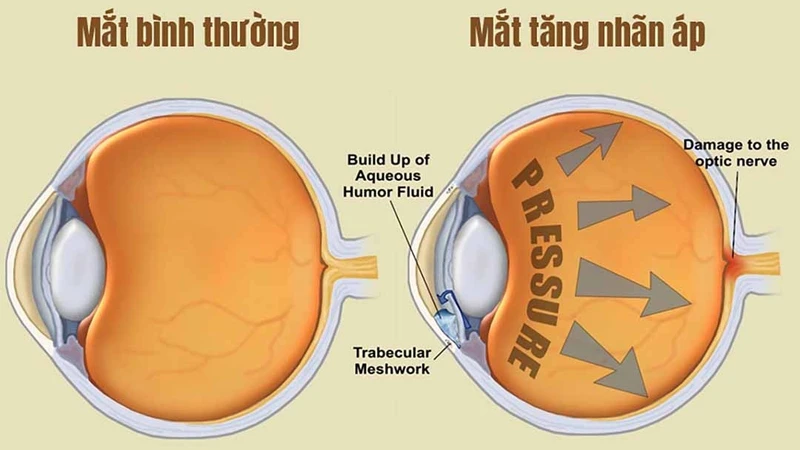 dau-hoc-mat3.jpg