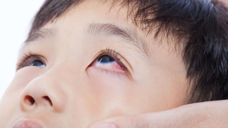 Viêm kết mạc do Adenovirus gây đỏ mắt và chảy nước mắt