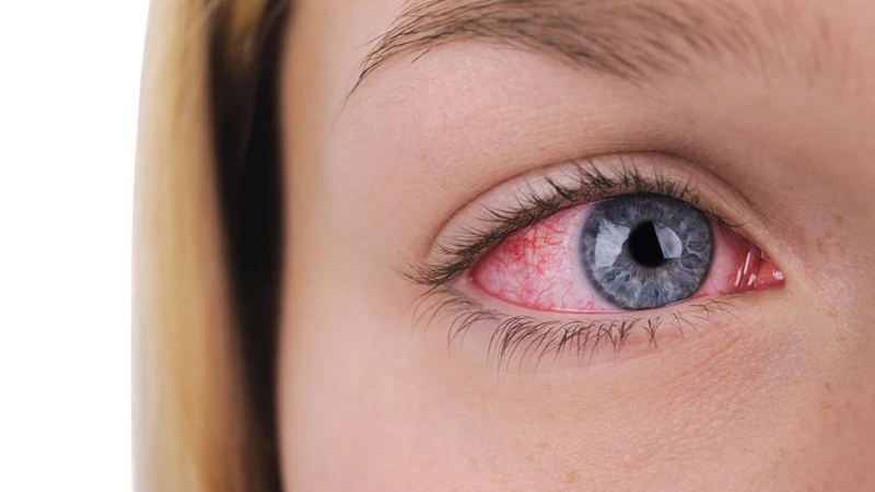 Đau mắt đỏ do virus: Triệu chứng, nguyên nhân và cách phòng ngừa 3