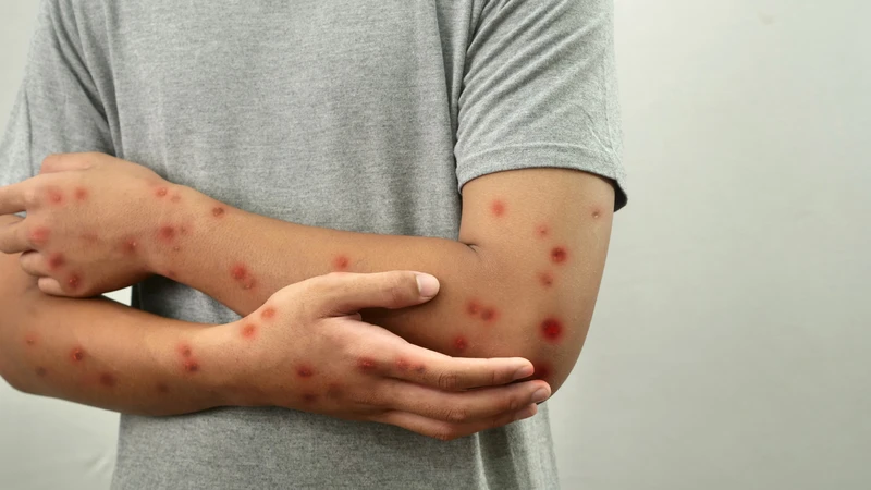 Đậu mùa khỉ có lây không? Cần làm gì để phòng ngừa bệnh? 1