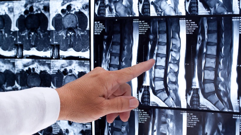 Bác sĩ có thể chỉ định MRI cột sống thắt lưng trong quá trình chẩn đoán