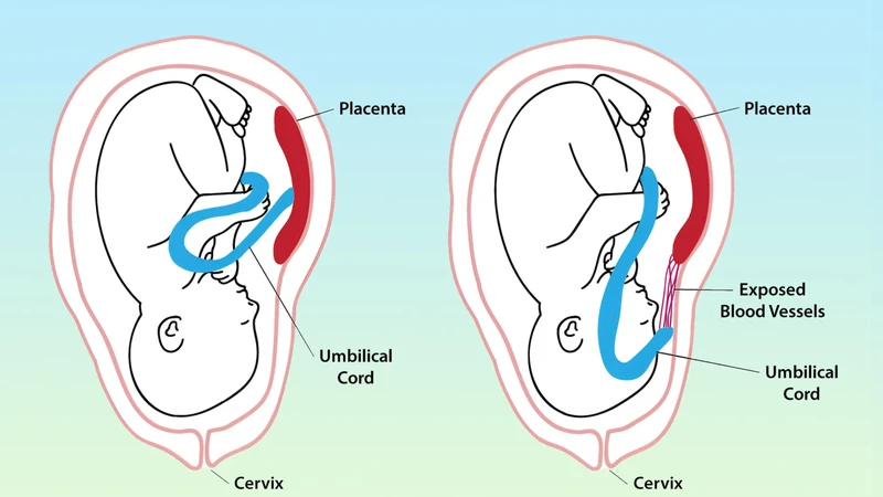 Dây rốn bám màng là một bất thường cấu trúc của dây rốn có thể được phát hiện qua siêu âm thai kỳ