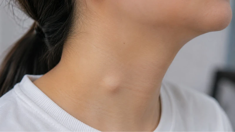 Dị dạng bạch huyết có thể gây khối sưng bất thường ở vùng cổ