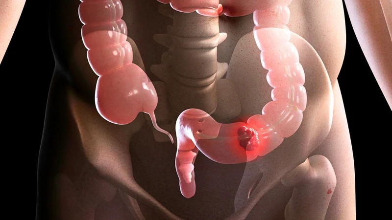 Đi ngoài ra máu là bị bệnh gì? 3