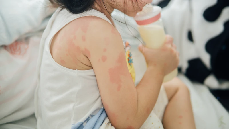 Trẻ em thường dễ bị dị ứng hơn người lớn