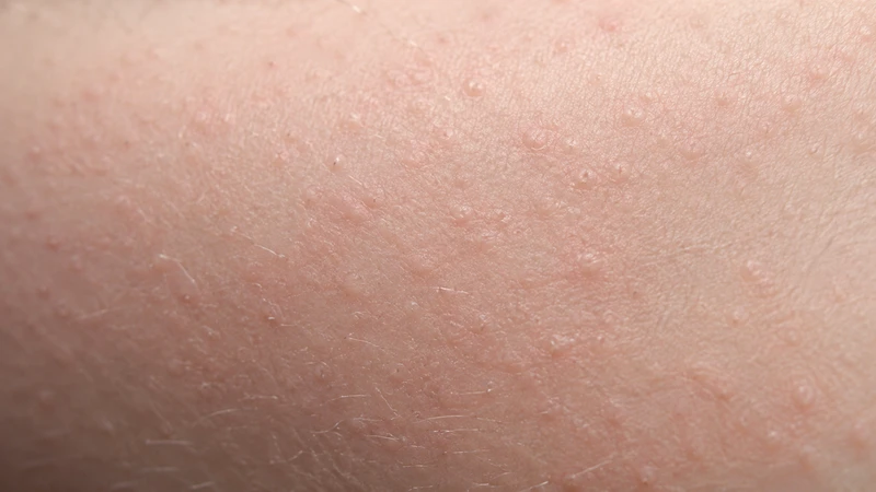 Dị ứng amoxicillin có thể gây phát ban, ngứa hoặc phản ứng nghiêm trọng