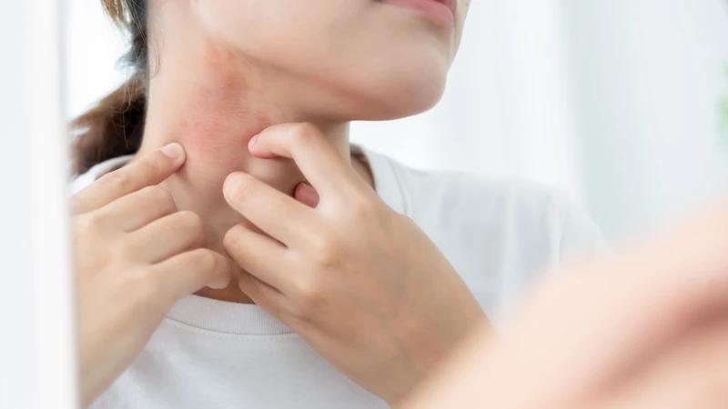 Phát ban và mề đay là những dấu hiệu thường gặp của dị ứng amoxicillin