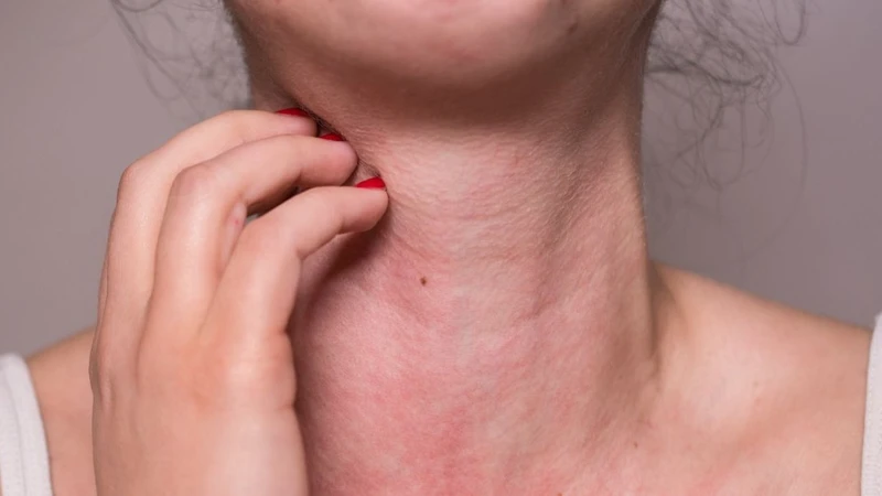 Có nhiều nguyên nhân gây dị ứng cá
