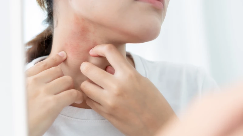 Phát ban đỏ trên da là một trong những dấu hiệu dị ứng phổ biến