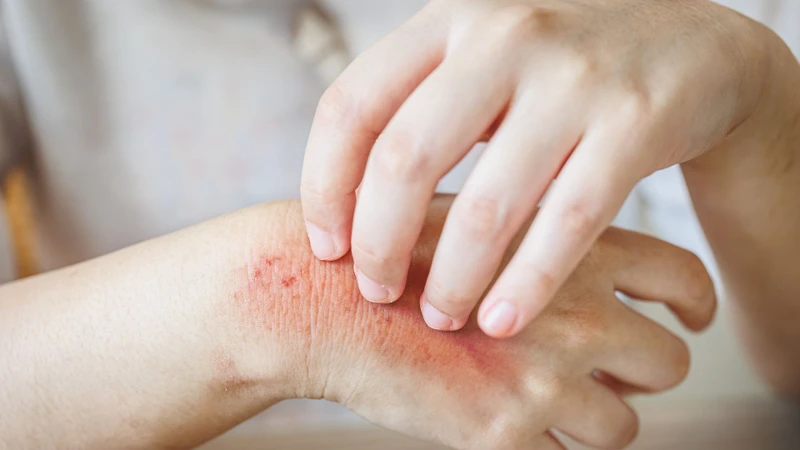 Dị ứng hải sản là gì? Cách nhận biết sớm và phòng tránh nguy hiểm 2