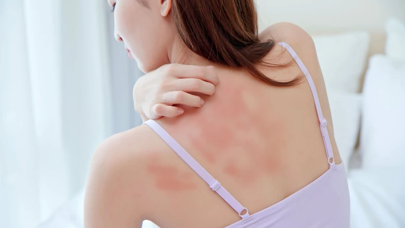 Dị ứng Ibuprofen là phản ứng quá mẫn khi hệ miễn dịch nhận diện nhầm thuốc là tác nhân gây hại