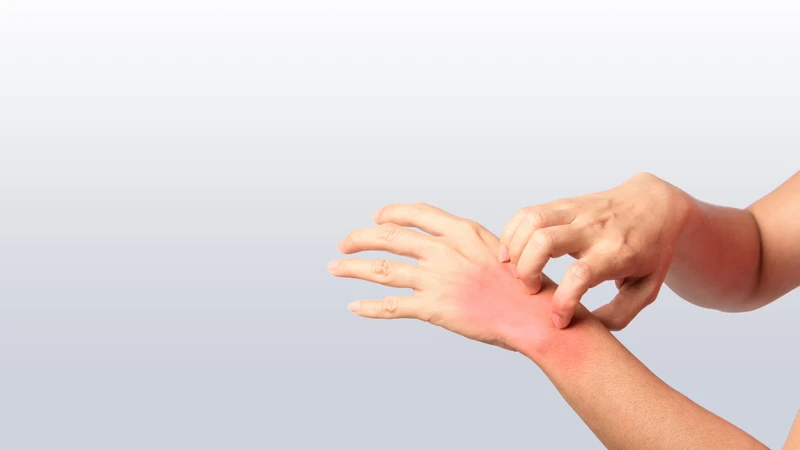Dị ứng nước mưa là gì? Những thông tin cần biết 2