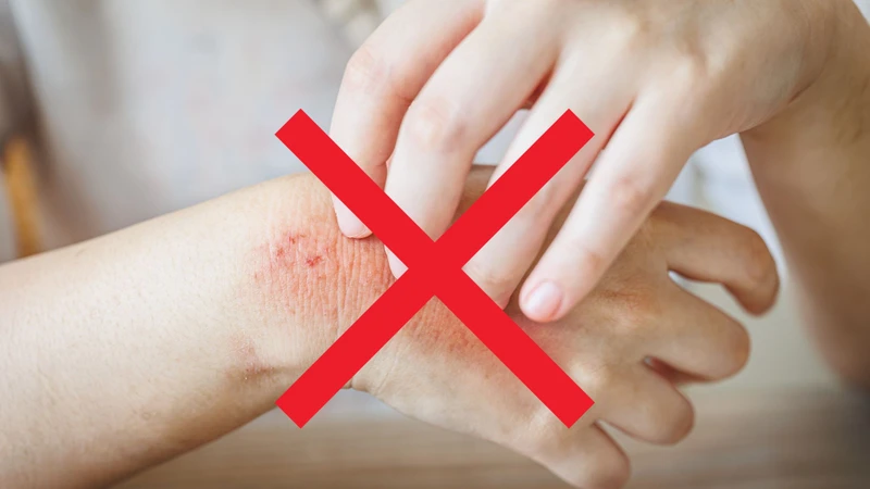 Dị ứng nước mưa là gì? Những thông tin cần biết 5