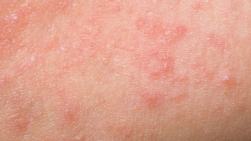 Dị ứng ở trẻ em: Nguyên nhân, triệu chứng và cách xử lý chuyên sâu 2