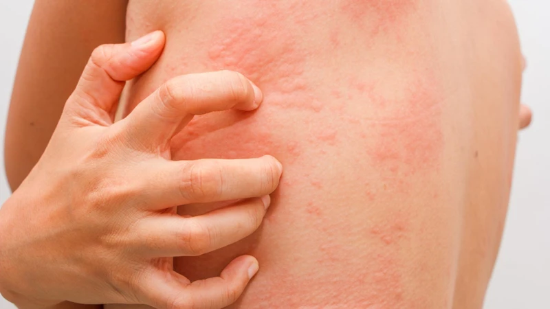 Nổi mề đay là một triệu chứng của dị ứng thức ăn