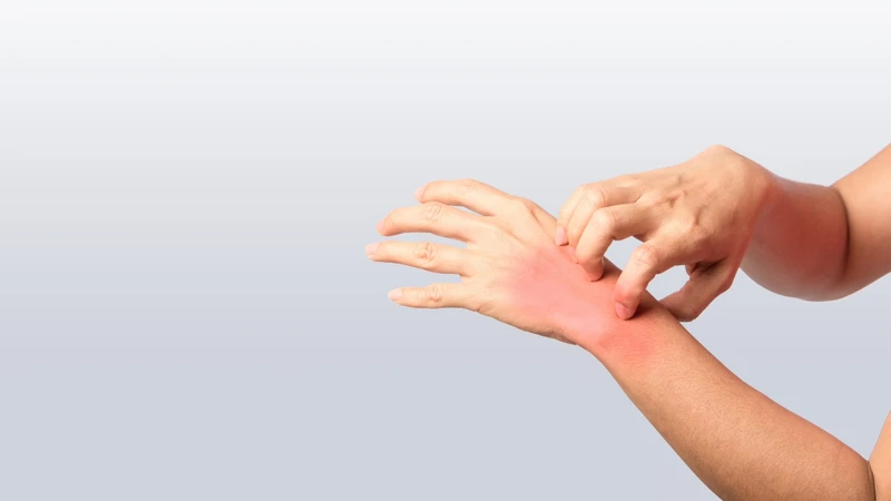 Người có tiền sử dị ứng với thuốc, thực phẩm hoặc hóa chất thường có nguy cơ cao hơn