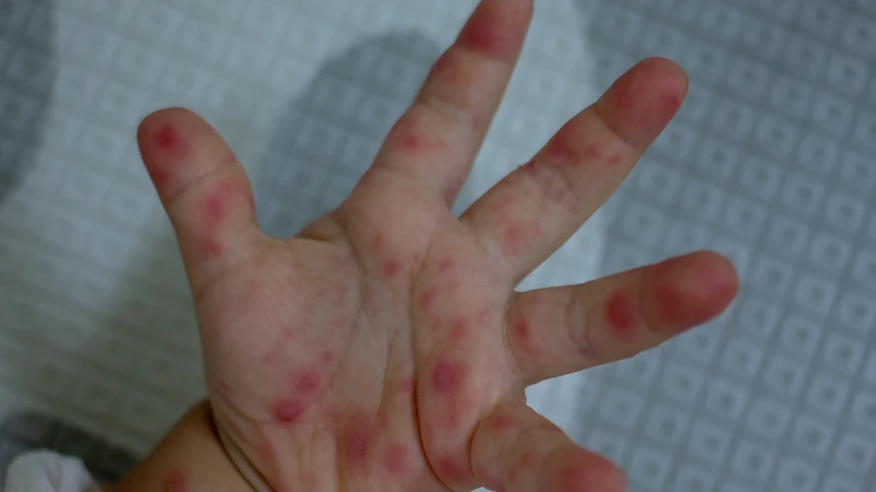 Dịch tay chân miệng tăng nhanh rõ rệt so với cùng kỳ năm ngoái