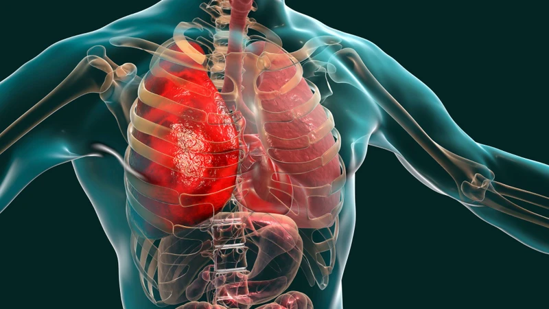 Điều trị phế cầu đúng phác đồ là như thế nào? Nguyên tắc điều trị bệnh do phế cầu khuẩn là gì? 4