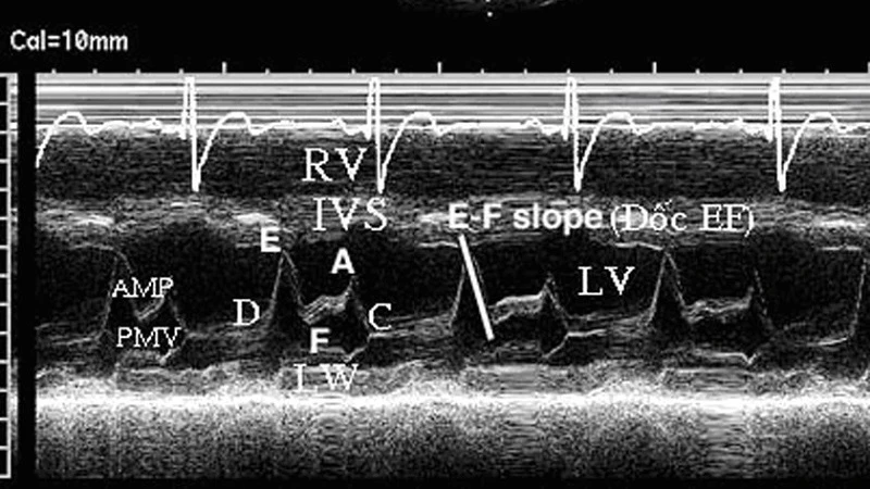 Các chỉ số EF, LV, LA, RV chỉ câu trúc tim