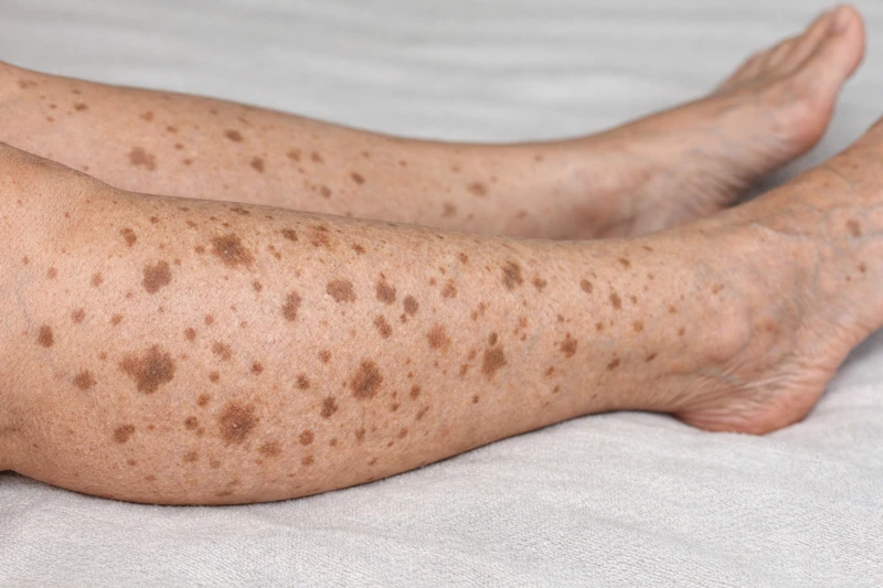 Yếu tố di truyền có liên quan đến sự xuất hiện của các vết đồi mồi ở chân