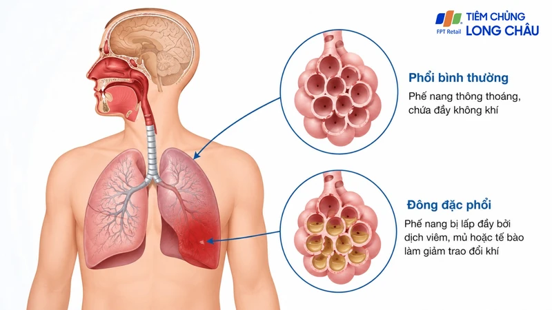 Đông đặc phổi là tình trạng nhu mô phổi bị thay thế không khí bằng dịch