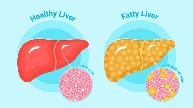 Gan nhiễm mỡ độ 2 là gì? Biến chứng và cách phòng ngừa bệnh 0