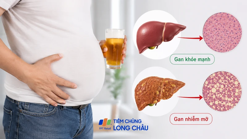 Gan nhiễm mỡ do rượu bia khiến mỡ tích tụ trong tế bào gan