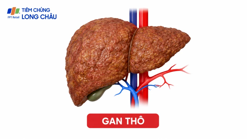 Gan thô có thể liên quan đến gan nhiễm mỡ, viêm gan hoặc xơ hóa gan