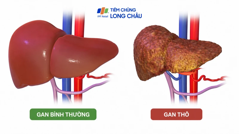 siêu âm có thể phát hiện những thay đổi sớm ở cấu trúc gan
