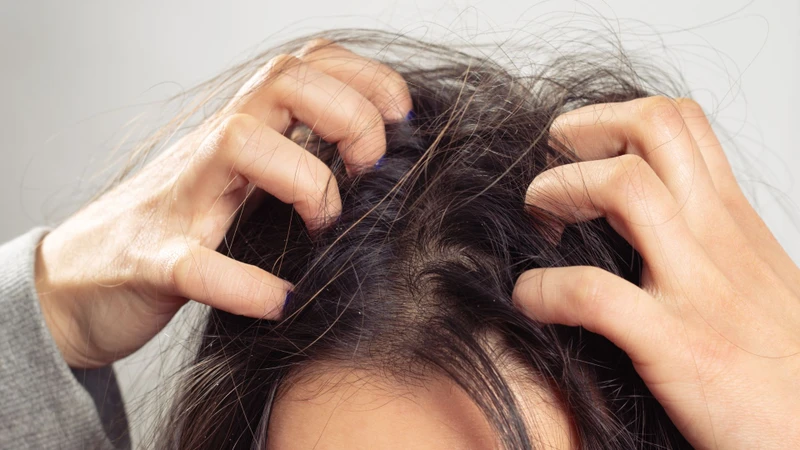Tìm hiểu gàu là gì giúp bạn nhận biết các yếu tố làm tăng nguy cơ xuất hiện gàu
