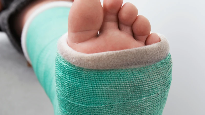 Gãy ngón chân út có cần bó bột không? Phần lớn tự lành nhưng bác sĩ vẫn có thể yêu cầu cố định khi cần